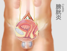 膀胱炎